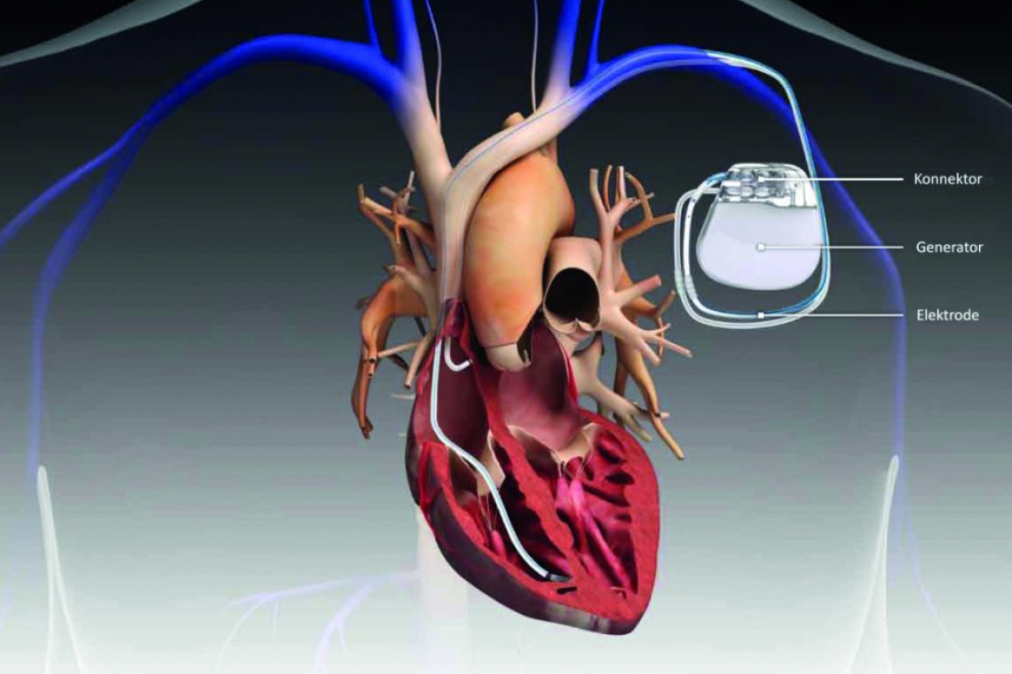 Neues Design von Herzschrittmachern